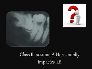 Class II position A Horizontally
impacted 48
 