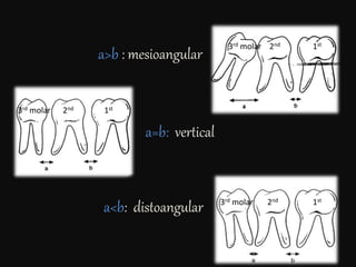 a>b : mesioangular
a=b: vertical
a<b: distoangular
3rd molar 2nd 1st
3rd molar 2nd 1st
3rd molar 2nd 1st
 