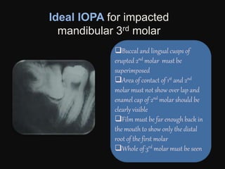 Ideal IOPA for impacted
mandibular 3rd molar
Buccal and lingual cusps of
erupted 2nd molar must be
superimposed
Area of contact of 1st and 2nd
molar must not show over lap and
enamel cap of 2nd molar should be
clearly visible
Film must be far enough back in
the mouth to show only the distal
root of the first molar
Whole of 3rd molar must be seen
 
