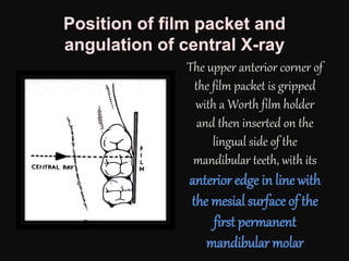 The upper anterior corner of
the film packet is gripped
with a Worth film holder
and then inserted on the
lingual side of the
mandibular teeth, with its
anterior edge in line with
the mesial surface of the
first permanent
mandibular molar
 