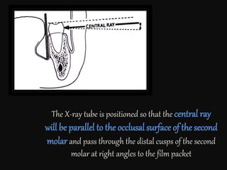The X-ray tube is positioned so that the central ray
will be parallel to the occlusal surface of the second
molar and pass through the distal cusps of the second
molar at right angles to the film packet
 