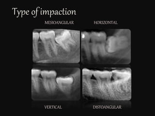 Type of impaction
MESIOANGULAR HORIZONTAL
VERTICAL DISTOANGULAR
 