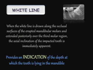 WHITE LINE
When the white line is drawn along the occlusal
surfaces of the erupted mandibular molars and
extended posteriorly over the third molar region,
the axial inclination of the impacted tooth is
immediately apparent.
Provides an INDICATIONof the depth at
which the tooth is lying in the mandible
 
