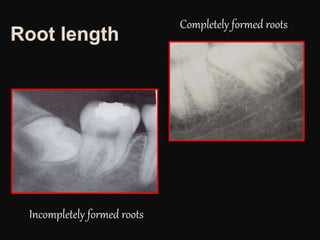 Completely formed roots
Incompletely formed roots
 