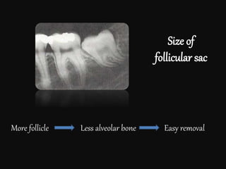 Size of
follicular sac
More follicle Less alveolar bone Easy removal
 