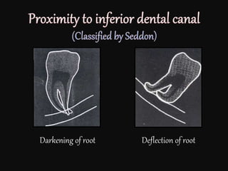 Darkening of root Deflection of root
 