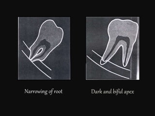 Dark and bifid apexNarrowing of root
 