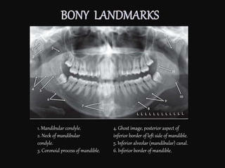 1. Mandibular condyle.
2. Neck of mandibular
condyle.
3. Coronoid process of mandible.
4. Ghost image, posterior aspect of
inferior border of left side of mandible.
5. Inferior alveolar (mandibular) canal.
6. Inferior border of mandible.
 