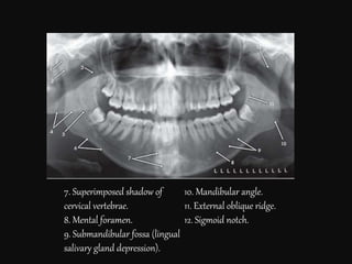 7. Superimposed shadow of
cervical vertebrae.
8. Mental foramen.
9. Submandibular fossa (lingual
salivary gland depression).
10. Mandibular angle.
11. External oblique ridge.
12. Sigmoid notch.
 