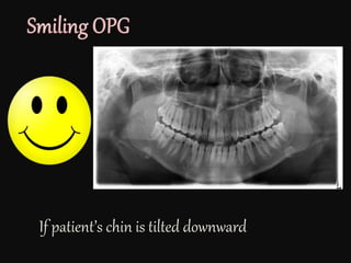 If patient’s chin is tilted downward
 