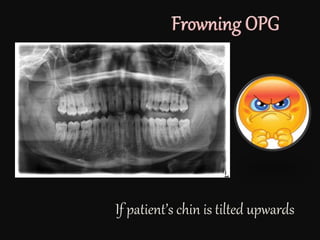 If patient’s chin is tilted upwards
 