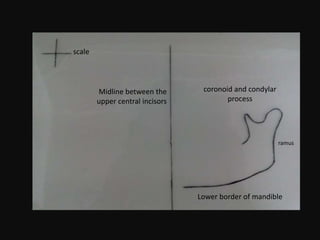 coronoid and condylar
process
ramus
Lower border of mandible
scale
Midline between the
upper central incisors
 