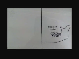 Exact teeth
outline
 