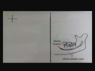 Inferior alveolar canal
Mental
foramen
 
