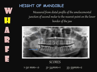 SCORES
1-30 mm= 0 31-34mm=1 35-39mm=2
Measured from distal profile of the amelocemental
junction of second molar to the nearest point on the lower
border of the jaw
HEIGHT OF MANDIBLE
 