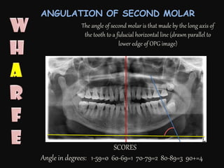 SCORES
Angle in degrees: 1-59=0 60-69=1 70-79=2 80-89=3 90+=4
The angle of second molar is that made by the long axis of
the tooth to a fiducial horizontal line (drawn parallel to
lower edge of OPG image)
ANGULATION OF SECOND MOLAR
 