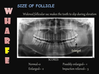 SCORES
Normal=0 Possibly enlarged= -1
Enlarged= -2 Impaction relieved= -3
Enlarged
Widened follicular sac makes the tooth to slip during elevation
SIZE OF FOLLICLE
 