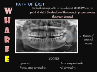SCORES
Space=0 Distal cusp covered=1
Mesial cusp covered=2 All covered=3
The tooth is imagined to be rotated about MIDPOINT and the
point at which the shadow of the coronoid process crosses
the crown is noted
PATH OF EXIT
Midpoint
Shadow of
coronoid
process
 