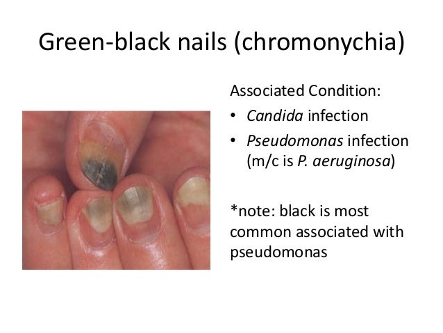 Pseudomonas Aeruginosa Nail Infection Treatment 34 green black nails
