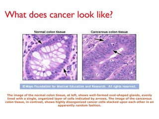 The image of the normal colon tissue, at left, shows well-formed oval-shaped glands, evenly lined with a single, organized layer of cells indicated by arrows. The image of the cancerous colon tissue, in contrast, shows highly disorganized cancer cells stacked upon each other in an apparently random fashion. What does cancer look like? 