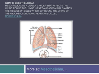 What is Mesothelioma?Mesothelioma is a deadly cancer that affects the lining round the lungs, heart and abdominal cavities. The tissues or cells which surround the lining of the abdomen, lungs and heart are called mesothelium. More at: Mesothelioma… 