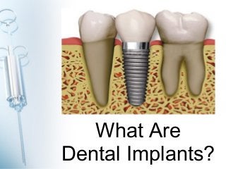 What Are 
Dental Implants? 
 