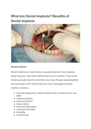 What Are Dental Implants? Benefits of
Dental Implants
Dental Implants
Dental implants are metal fixtures, surgically fastened to your jawbone
below the gums, onto which artificial teeth can be mounted. These metal
implants actually become anchored to your bone through osseointegration
(the bone fuses to the metal).There are many advantages to dental
implants, including:
● Improved appearance. Dental implants look and feel like your own
teeth.
● Improved speech.
● Improved comfort.
● Easier eating.
● Improved self-esteem.
● Improved oral health.
● Durability.
● Convenience.
 
