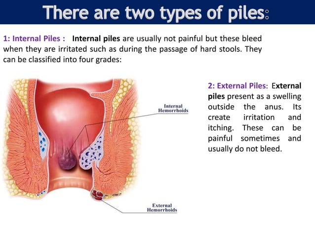 Non Inflamed Pile What are piles and its homeopathic treatment. | PPT