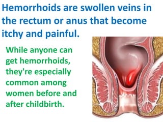 What are symptoms of hemorrhoids | PPTX