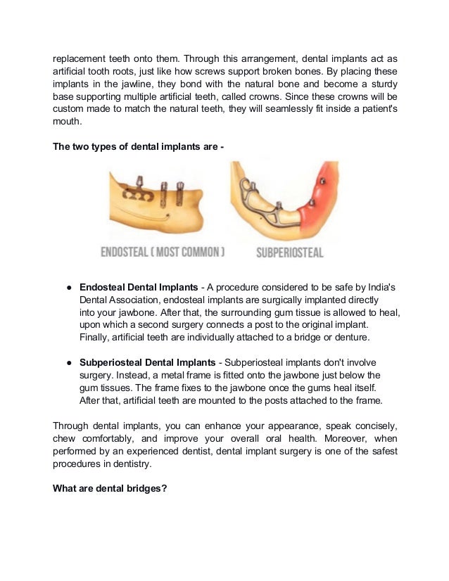 What are the differences between dental implants and bridges