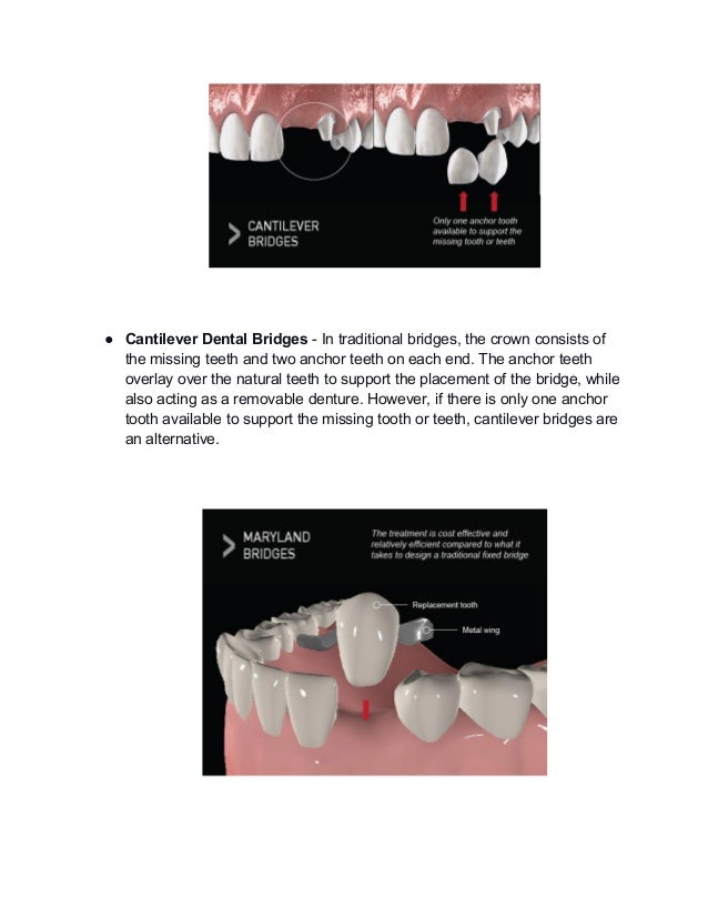 What are the differences between dental implants and bridges