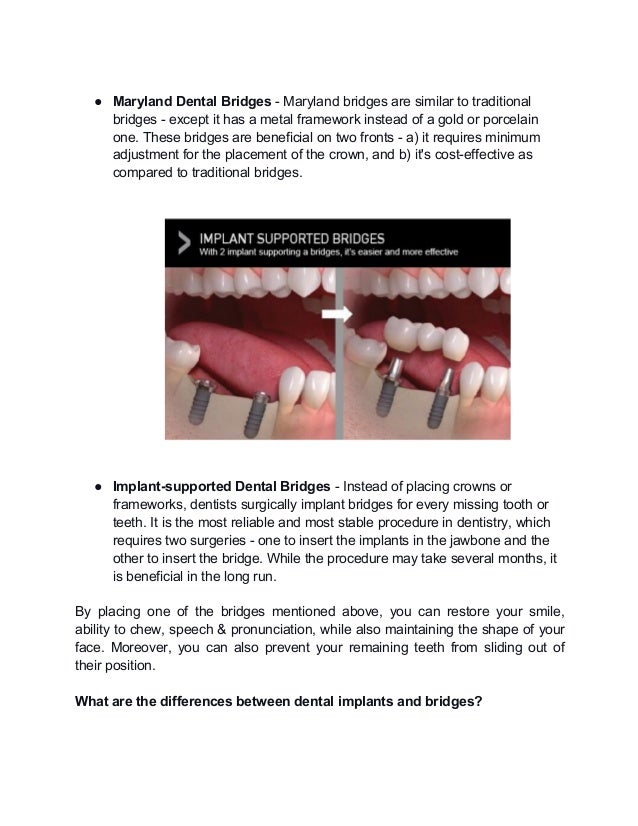 What are the differences between dental implants and bridges