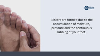 Blisters are formed due to the
accumulation of moisture,
pressure and the continuous
rubbing of your foot.
 