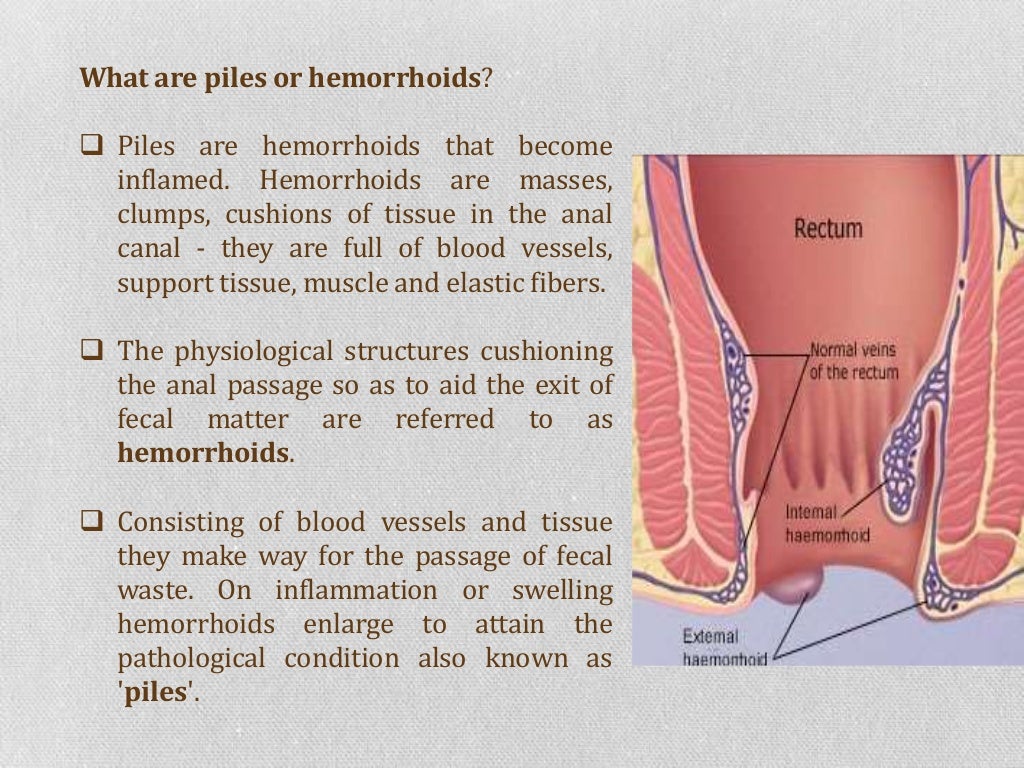 What are the treatment options for piles