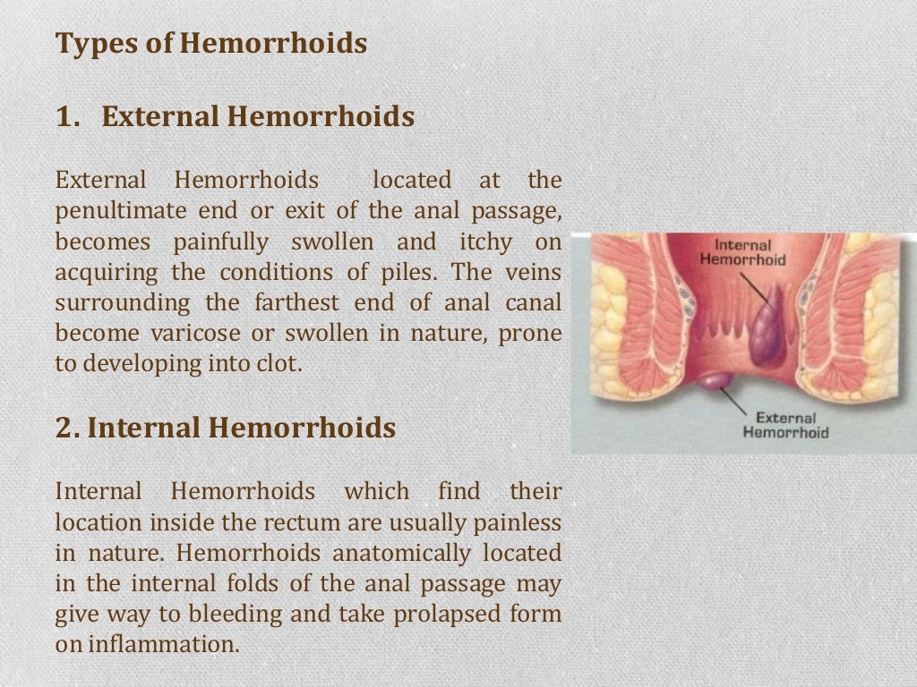What are the treatment options for piles