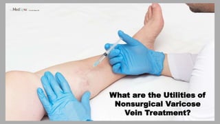 What are the Utilities of
Nonsurgical Varicose
Vein Treatment?
 