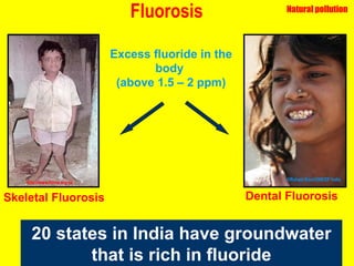 Fluorosis ©Ruhani Kaur/UNICEF India  http://www.fannz.org.nz 20 states in India have groundwater that is rich in fluoride Dental Fluorosis Skeletal Fluorosis Excess fluoride in the body  (above 1.5 – 2 ppm) Natural pollution 