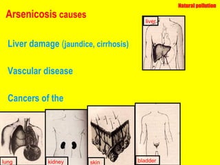 Arsenicosis  causes Liver damage  ( jaundice, cirrhosis) Vascular disease Cancers of the lung kidney bladder skin Natural pollution liver 