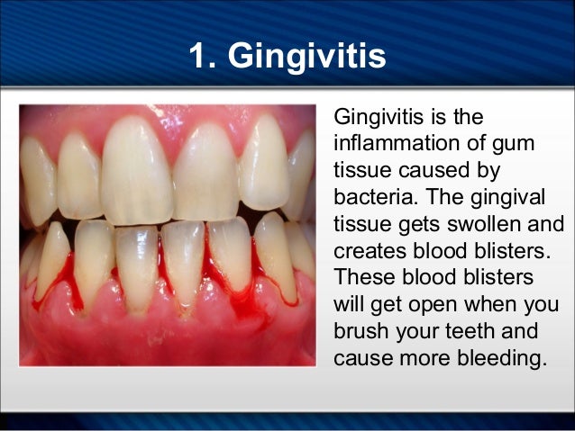 Cause Of Bleeding Gums When Brushing Teeth - TeethWalls