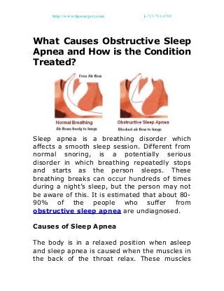 http://www.hpcsurgery.com 1-713-791-0700
What Causes Obstructive Sleep
Apnea and How is the Condition
Treated?
Sleep apnea is a breathing disorder which
affects a smooth sleep session. Different from
normal snoring, is a potentially serious
disorder in which breathing repeatedly stops
and starts as the person sleeps. These
breathing breaks can occur hundreds of times
during a night’s sleep, but the person may not
be aware of this. It is estimated that about 80-
90% of the people who suffer from
obstructive sleep apnea are undiagnosed.
Causes of Sleep Apnea
The body is in a relaxed position when asleep
and sleep apnea is caused when the muscles in
the back of the throat relax. These muscles
 