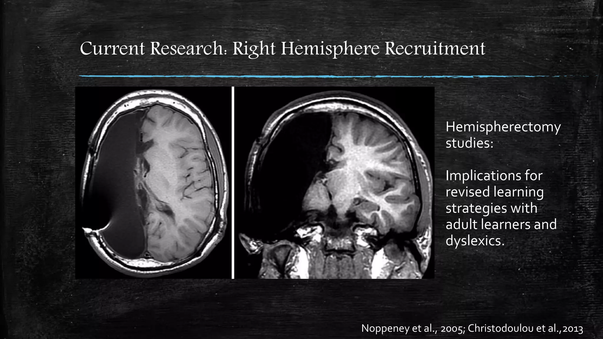 Current Research: Right Hemisphere Recruitment
Noppeney et al., 2005; Christodoulou et al.,2013
Hemispherectomy
studies:
Implications for
revised learning
strategies with
adult learners and
dyslexics.
 