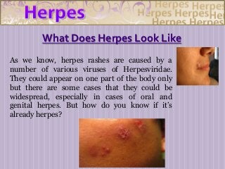 What Does Herpes Look Like
As we know, herpes rashes are caused by a
number of various viruses of Herpesviridae.
They could appear on one part of the body only
but there are some cases that they could be
widespread, especially in cases of oral and
genital herpes. But how do you know if it’s
already herpes?

 