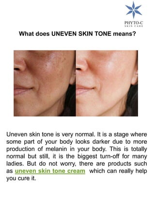 What does UNEVEN SKIN TONE means?
Uneven skin tone is very normal. It is a stage where
some part of your body looks darker due to more
production of melanin in your body. This is totally
normal but still, it is the biggest turn-off for many
ladies. But do not worry, there are products such
as uneven skin tone cream which can really help
you cure it.
 