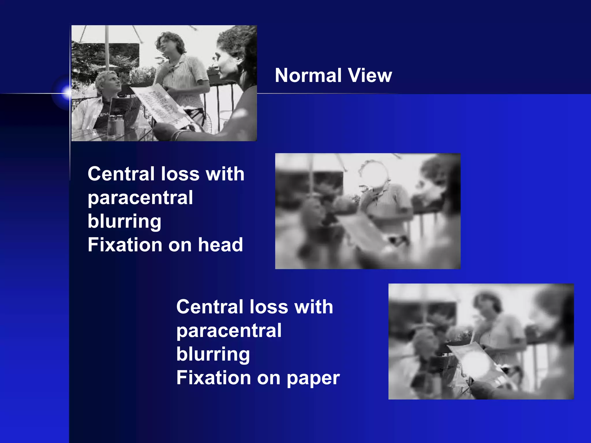 Normal View
Central loss with
paracentral
blurring
Fixation on head
Central loss with
paracentral
blurring
Fixation on paper
 