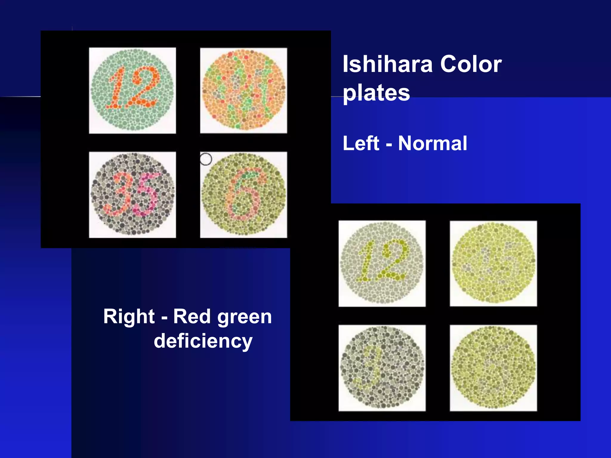 Ishihara Color
plates
Left - Normal
Right - Red green
deficiency
 