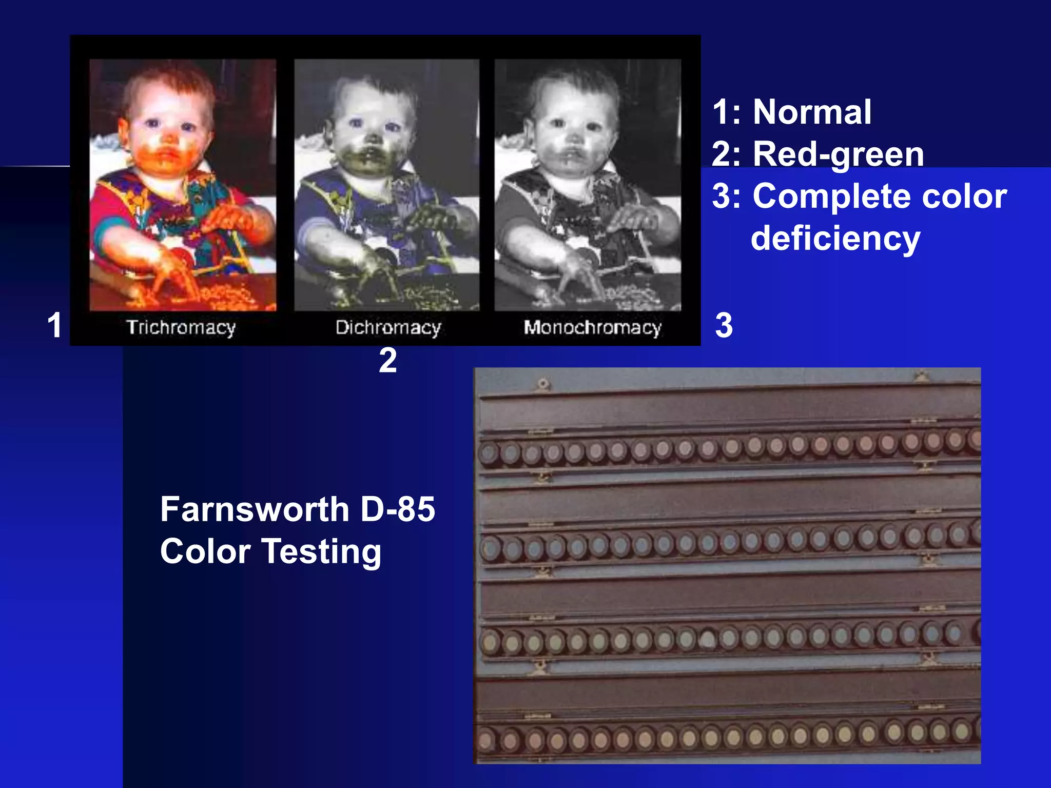 Farnsworth D-85
Color Testing
1: Normal
2: Red-green
3: Complete color
deficiency
1
2
3
 
