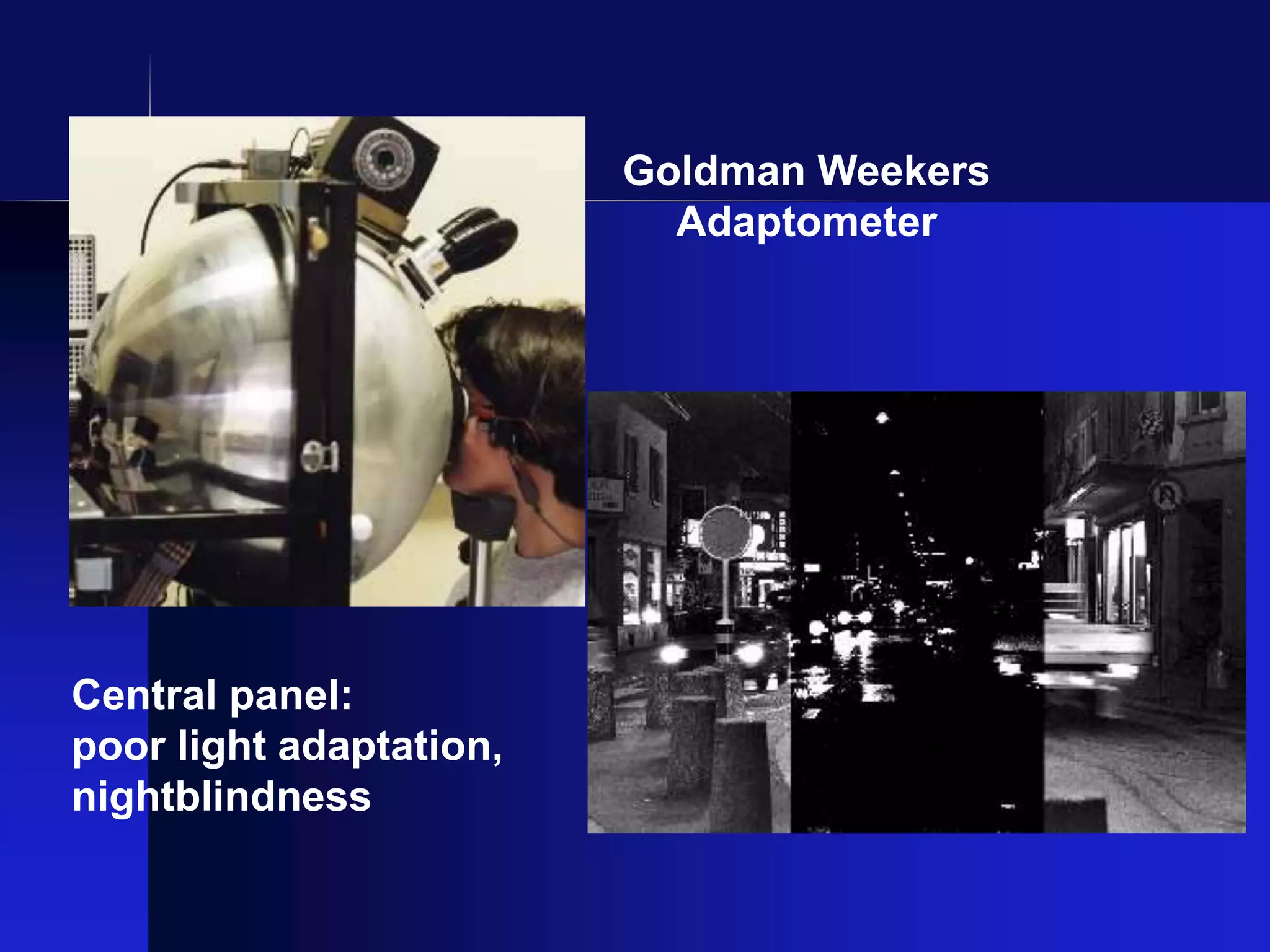 Goldman Weekers
Adaptometer
Central panel:
poor light adaptation,
nightblindness
 