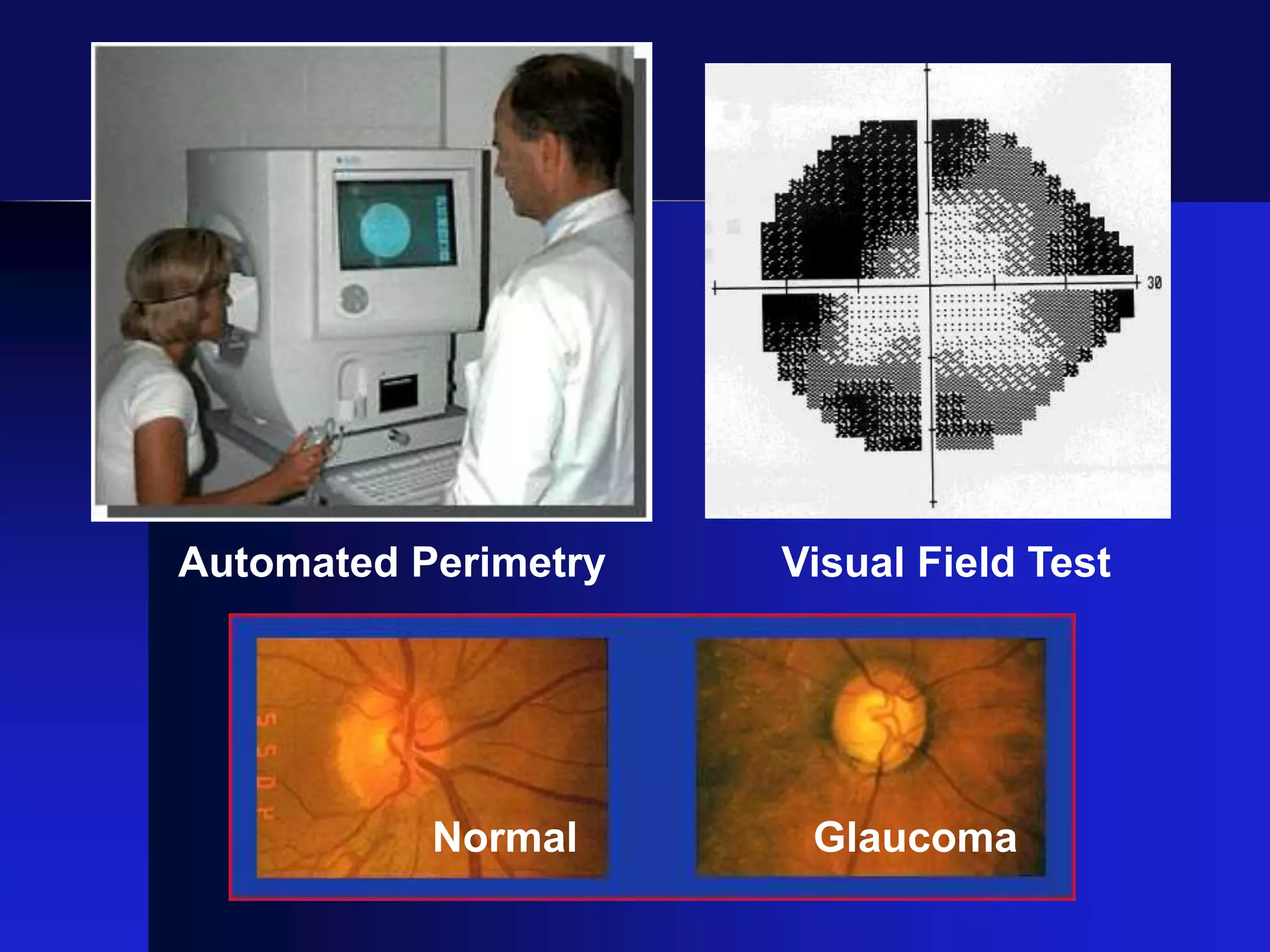 Normal Glaucoma
Visual Field TestAutomated Perimetry
 