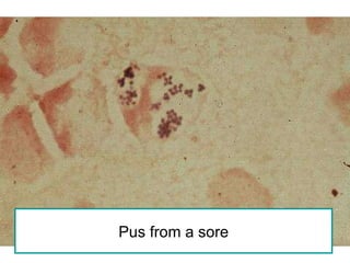 Pus from a sore 