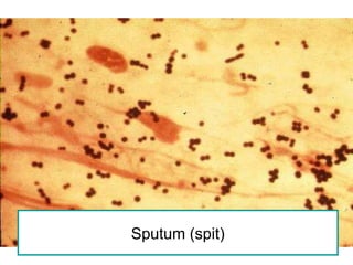 Sputum (spit) 
